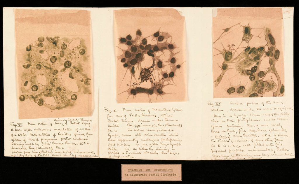 Illustration depicting different views of the Spanish flu virus. Each one is labelled with a handwritten description underneath. At the bottom is a typed label reading “Diagrams and manuscripts to illustrate Portal Cirrhosis”.